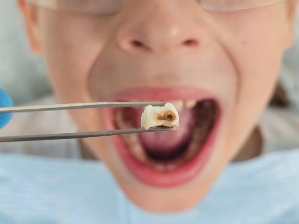 Best Urgent Dental Care for Toothache in Dunwoody, GA